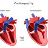 Sybil Wilkes Exclusive: King McClure, Jared Butler And Heart Experts Talk Hypertrophic Cardiomyopathy (HCM)